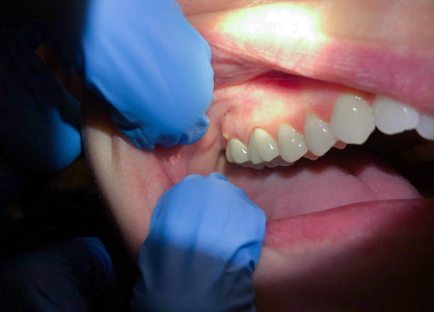 Best Broken Tooth Emergency  in Sugarmill Woods, FL